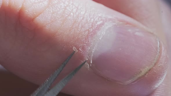 The Process of Removing of the Hangnails Using the Scissors