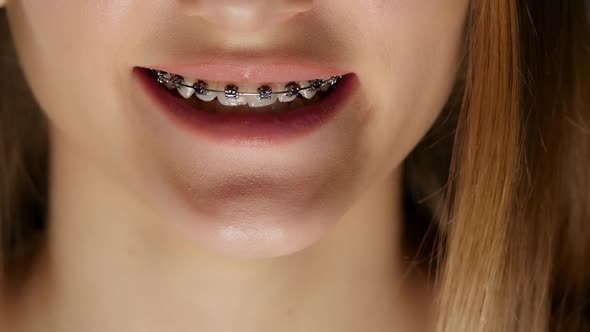 Braces. Black. Closeup alt