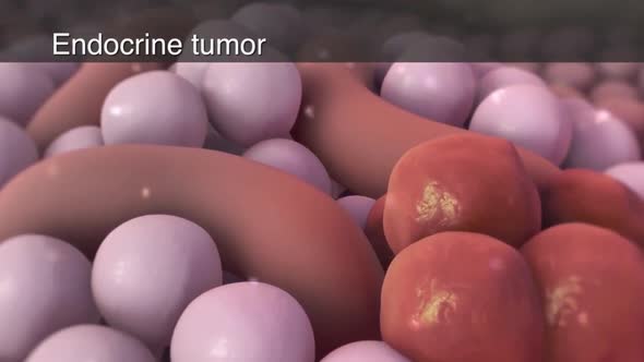 pancreatic cancer  medical animation alt