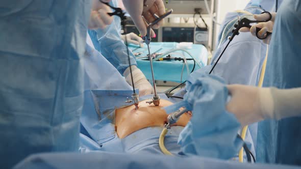 Close Up of Hands of Surgeons Team During Operation Uterus Removal with ...