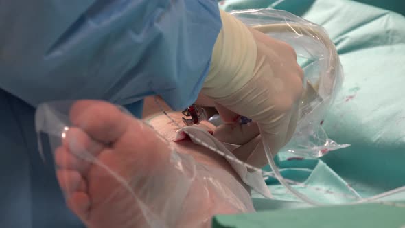 Endovenous laser ablation (EVLA) is a commonly used and very effective minimally invasive therapy to alt