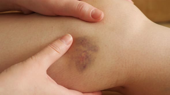 Woman Examines and Feels the Bruise on Her Leg alt