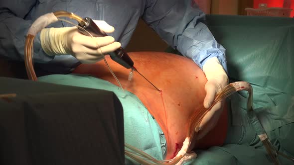 Liposuction And  Belly Fat 14