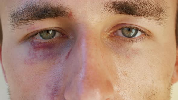 Portrait of a European Man with Bruises Under His Eyes alt