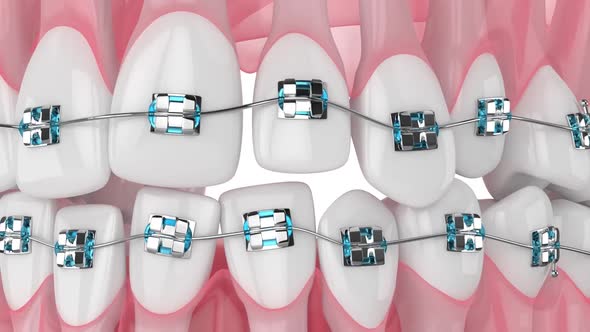 Closeup of teeth alignment by orthodontic braces