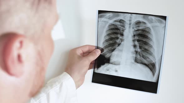 Radiologist  A Specialist Analyzes An X Ray Of A Person's Lungs On A White Background. Pneumonia