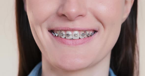Beautiful Female Smile in Dental Braces with Orthodontic Toothbrushes Closeup alt