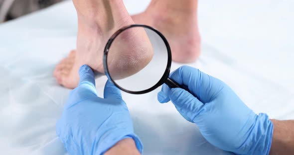 Doctor Examining Skin with Cracks on Heels of Female Patient Using Magnifying Glass Closeup Movie alt