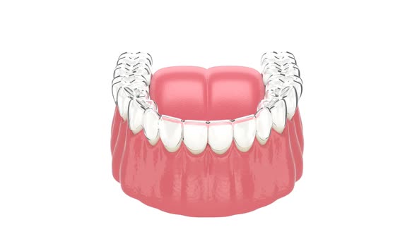Invisalign removable and invisible retainer placement on lower jaw 