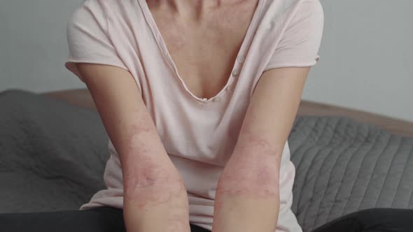 Inflammation of the Skin on the Arms alt
