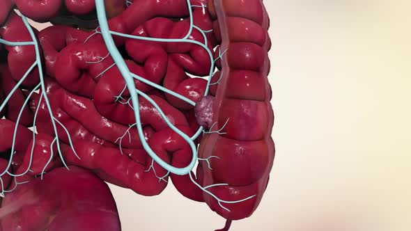 Effects of colon cancer on liver. 3D Medical Animation alt