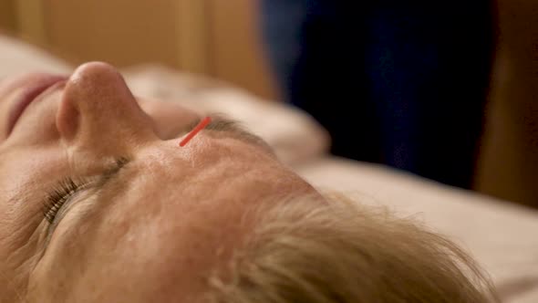 Detail of an acupuncture needle in the forehead of a caucasian woman at a spa. Woman is talking with alt