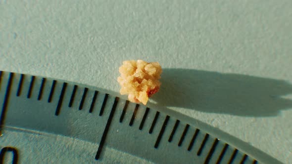 Macro Shooting A Stone From A Human Kidney ,Phosphate Or Urate Calculus From A Human Kidney 4 Mm. alt