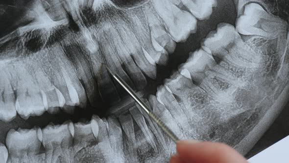 Panoramic Tomography of the Jaw Close-up. The Orthodontist Analyzes the Bite for Dental Treatment. alt