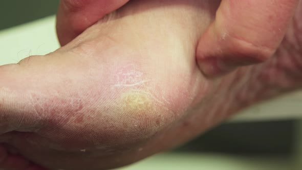 A Hand is Massaging a Man's Foot with a Callus alt