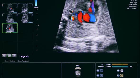 Scanner Display During Ultrasound with a Radar on It alt