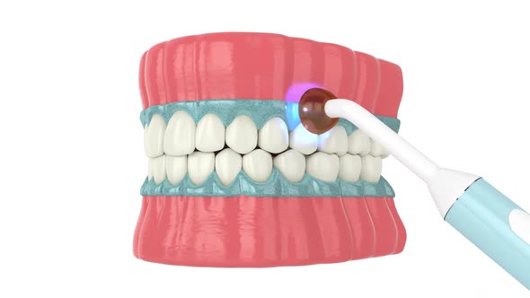 Teeth whitening process over white background