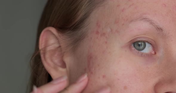 Woman touching post acne scars. alt