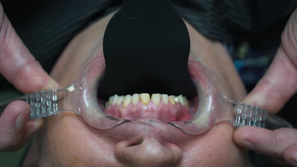 Patient's Teeth During the Surgery Close-up