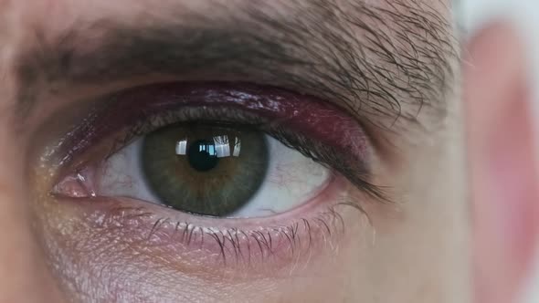 Real Black Eye on the Young Male Face Bruise on a Man Eyelid alt