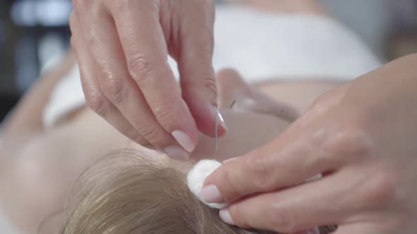 Unrecognizable Doctor Taking Out Needles From Scalp of Female Patient. Close-up Head of Young Blond alt
