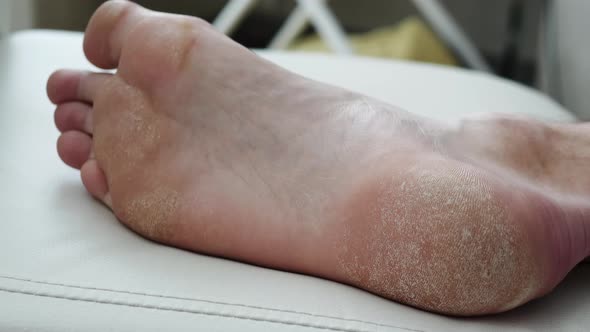 Human Foot. Dry Skin, Psoriasis Of The Feet. The Skin Is Damaged. Dermatitis, Eczema, Psoriasis