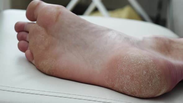 Human Foot. Dry Skin, Psoriasis Of The Feet. The Skin Is Damaged. Dermatitis, Eczema, Psoriasis alt