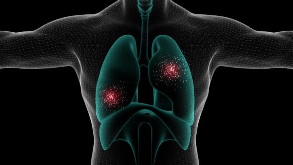 Chest Infection Visualization With Alpha