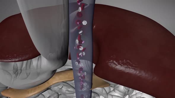 Diabetes is a metabolic disorder caused by high levels of blood sugar. alt