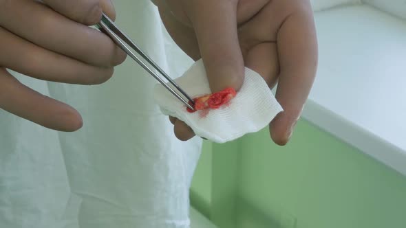 The Surgeon Shows a Thrombus Which He Cut Out of the Patient's Artery alt