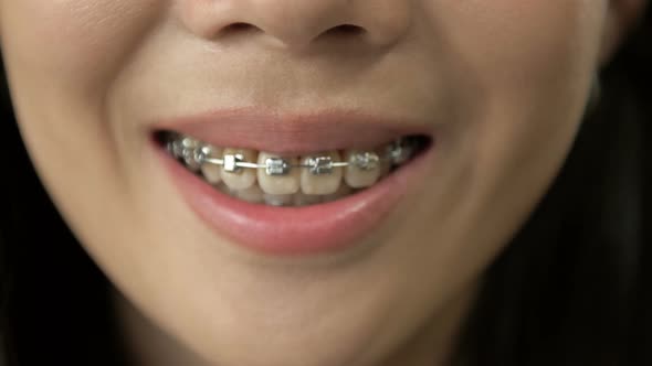 Beautiful Macro Shot of White Teeth with Braces