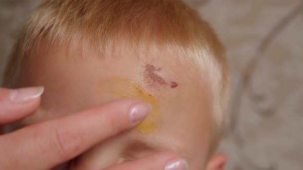A Caring Mother Applies Ointment to a Scratch and a Bump on Her Son's Forehead alt