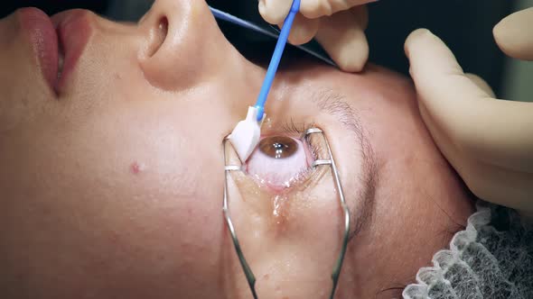 Doctor is Wiping Liquid Off of Patient's Eye During Surgery alt