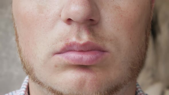 Apply The Herpes Ointment With A Cotton Swab. Close Up Of A Man With Herpes On His Lip.
