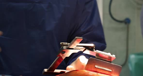 The Surgeon the Openheart Procedure Chest During Heart Surgery alt