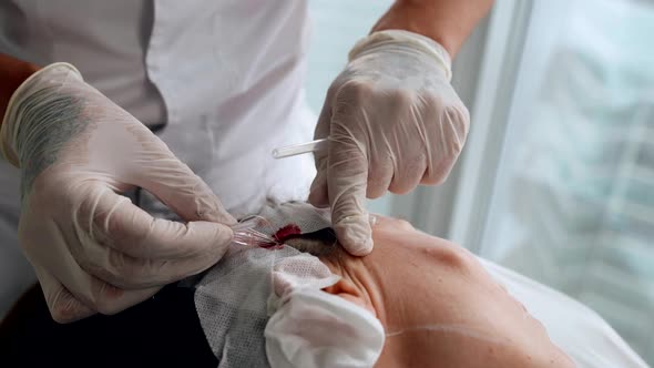 Threadlifting with Mesothreads at Aesthetic Clinic Installing Threadkogi Under Facial Skin alt