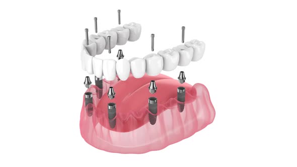 Dental prosthesis all-on-6 system supported by implants