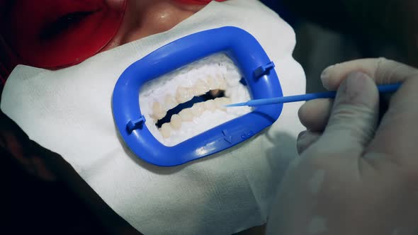Bleaching Paste is Being Applied Onto Patient's Teeth alt