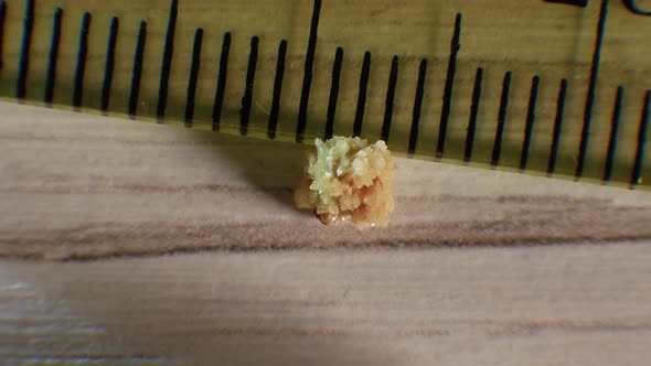 Top View Oxalate Kidney Stone, The Stone Is Removed From The Kidney, Close Up Of The Kidney Stone