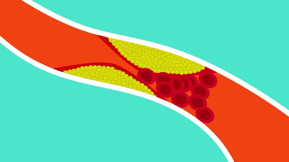 Fat blocking blood circulation inside a blood vessel 4K animation