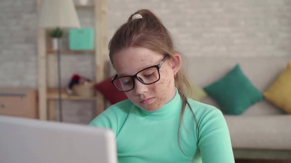 Portrait of a Teenage Girl with a Defect or Face Burn Using a Laptop or Computer alt