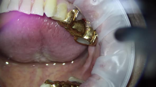 The dental gold bridge of the upper jaw of a person is washed with a stream of water