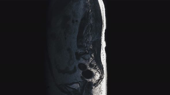 Postoperative Voluminous Color MRI of Female Organs for the Detection of Metastases alt