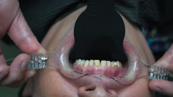 Patient's Teeth Close-up Under the Operation