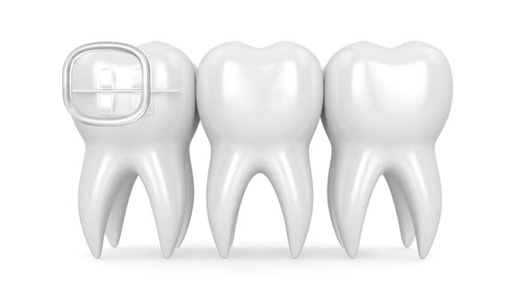Teeth with three types of orthodontic braces