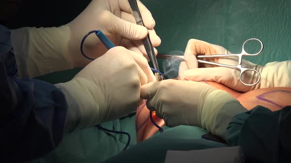 Breast Augmentation And Reconstruction Surgery 2