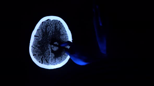 Doctor with a pen checking a tomography scan of a brain with cancer tumor