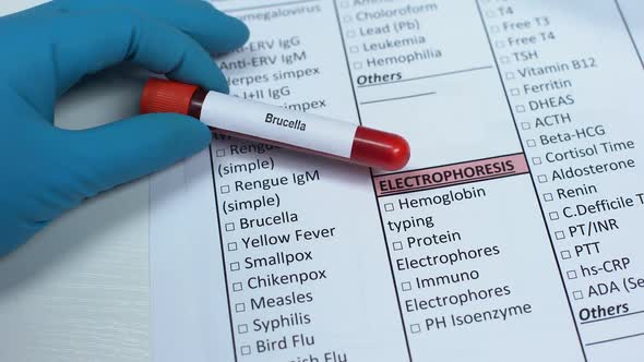 Brucella, Doctor Checking Bacteria in Lab Blank, Showing Blood Sample in Tube alt