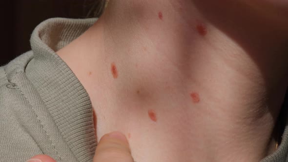 Birthmarks on Skin Close Up Detail of the Bare Skin Sun Exposure Effect on Skin Health Effects of UV alt