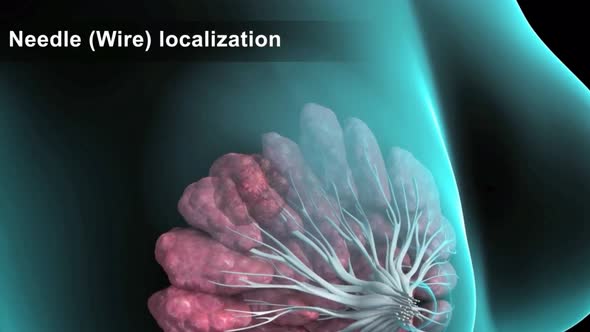 A sample is taken to examine the tumorous breast. Biopsy alt